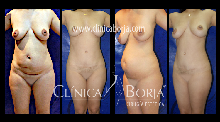 fascia scarpa