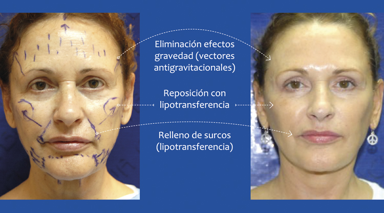 vectores antigravitacionales