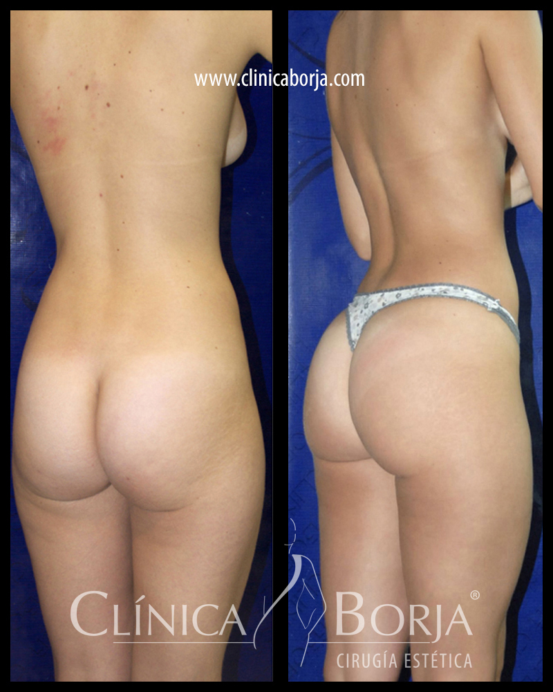 lipo