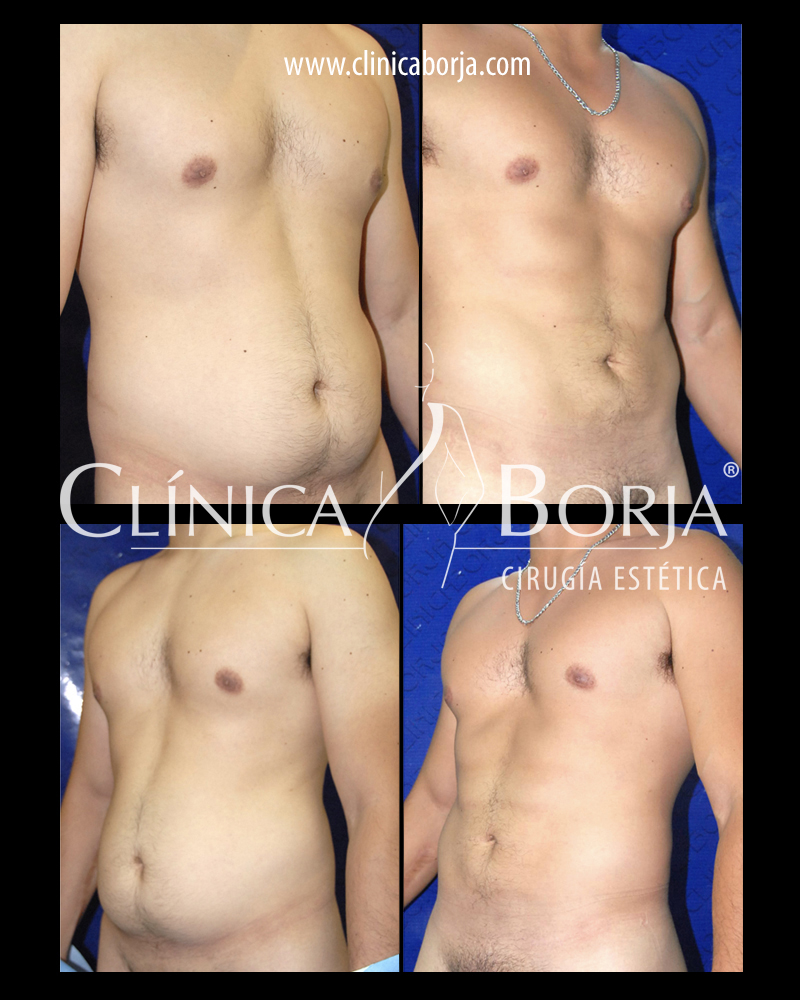 abdomen