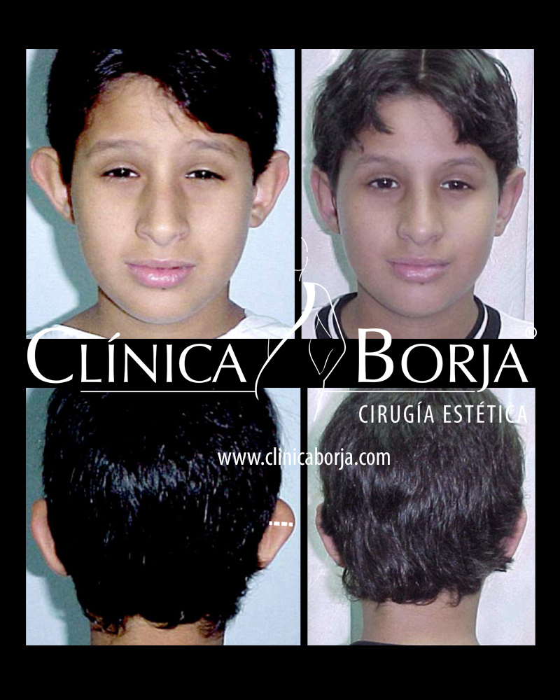 orejas